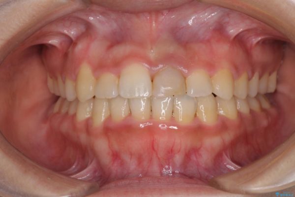 前歯の反対咬合　非抜歯のワイヤー矯正 治療後画像