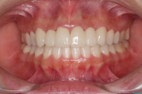 審美歯科治療と矯正歯科治療で気になる前歯を美しく アフター