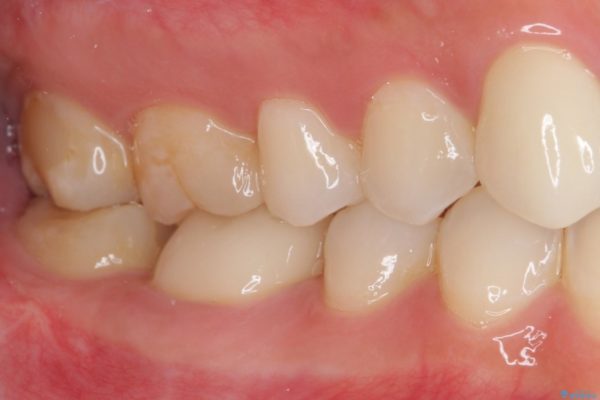 審美歯科治療と矯正歯科治療で気になる前歯を美しく 治療後画像