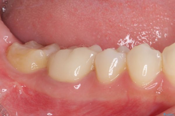 審美歯科治療と矯正歯科治療で気になる前歯を美しく 治療後画像