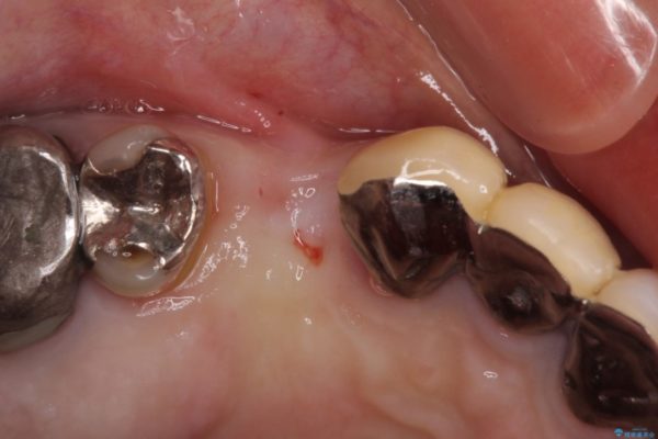 小臼歯の審美治療　ストローマンインプラントとカスタムアバットメント 治療前画像