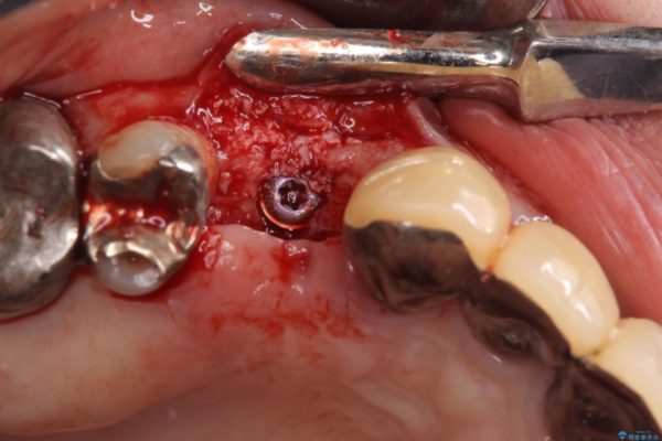 小臼歯の審美治療　ストローマンインプラントとカスタムアバットメント 治療後画像