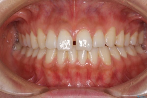 気になる前歯の隙間をオールセラミックで閉じる 治療前画像