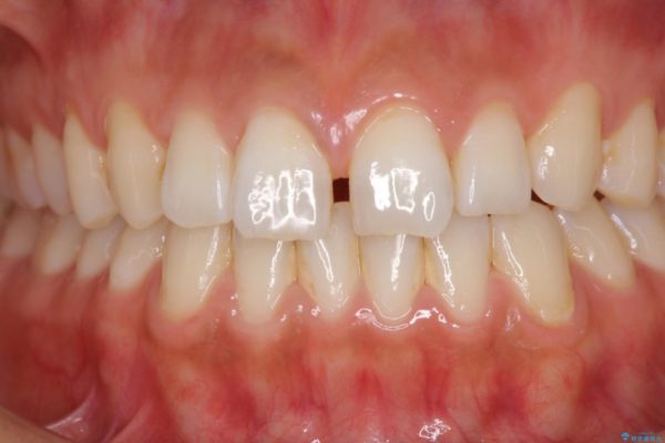 気になる前歯の隙間をオールセラミックで閉じる 治療前画像