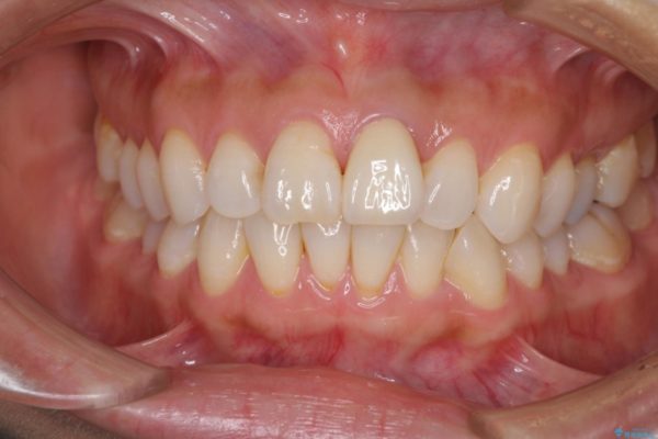 変色と捻じれの解消　前歯のオールセラミッククラウン 治療後画像