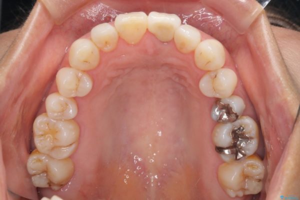 変色と捻じれの解消　前歯のオールセラミッククラウン 治療後画像