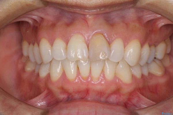 変色と捻じれの解消　前歯のオールセラミッククラウン 治療前画像