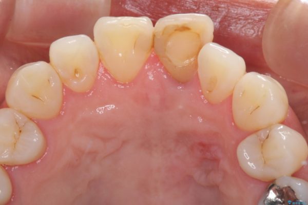 変色と捻じれの解消　前歯のオールセラミッククラウン 治療前画像