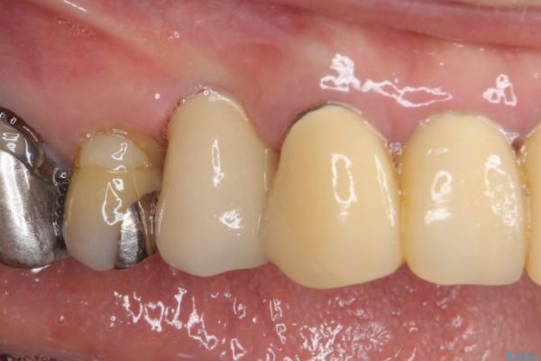 小臼歯の審美治療　ストローマンインプラントとカスタムアバットメント 治療後画像
