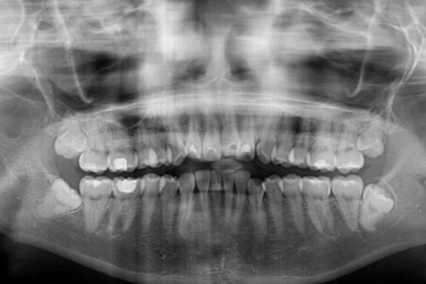 デコボコで飛び出した前歯をきれいに　インビザラインによる矯正治療 治療前画像