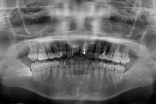前歯の反対咬合　非抜歯のワイヤー矯正 治療前画像