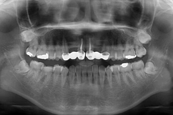 審美歯科治療と矯正歯科治療で気になる前歯を美しく 治療前画像