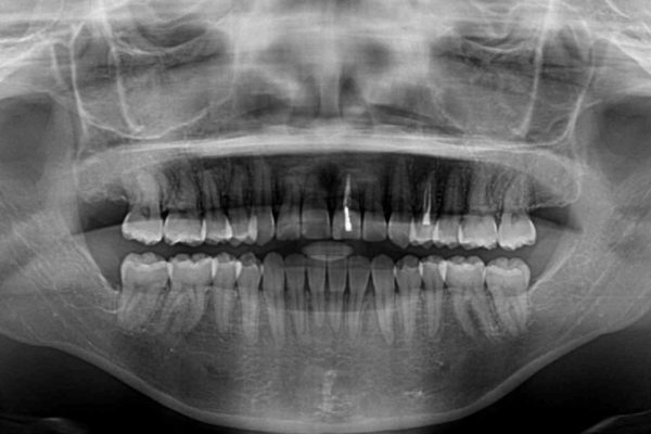 前歯の反対咬合　非抜歯のワイヤー矯正 治療後画像