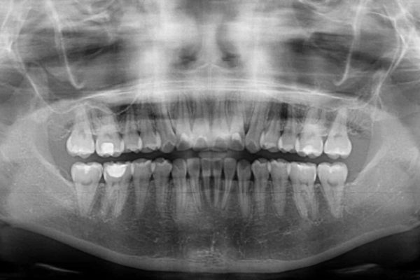 デコボコで飛び出した前歯をきれいに　インビザラインによる矯正治療 治療後画像
