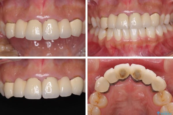 審美歯科治療と矯正歯科治療で気になる前歯を美しく 治療前画像