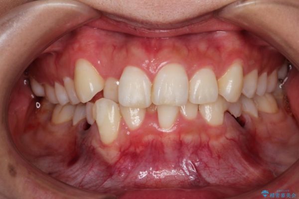 前歯の反対咬合を改善　上下裏側の抜歯矯正 ビフォー