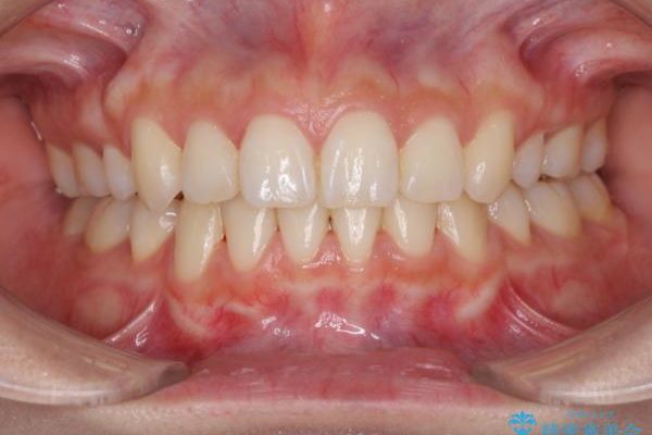 前歯の反対咬合を改善　上下裏側の抜歯矯正 アフター