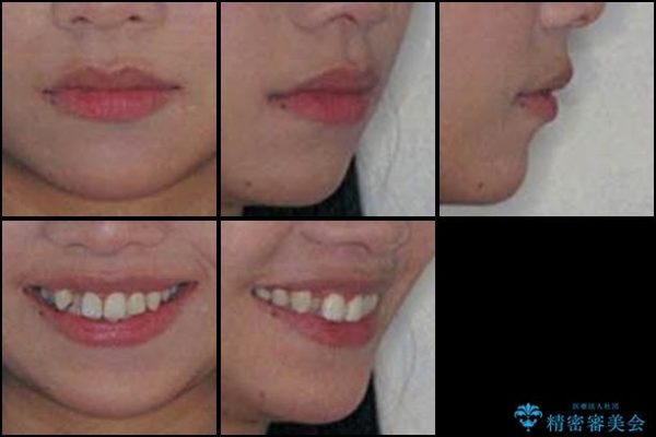 前歯の反対咬合を改善　上下裏側の抜歯矯正 治療前画像