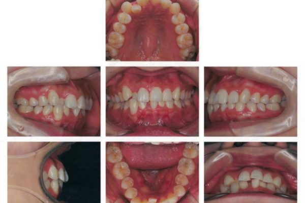 前歯の反対咬合を改善　上下裏側の抜歯矯正 治療前画像