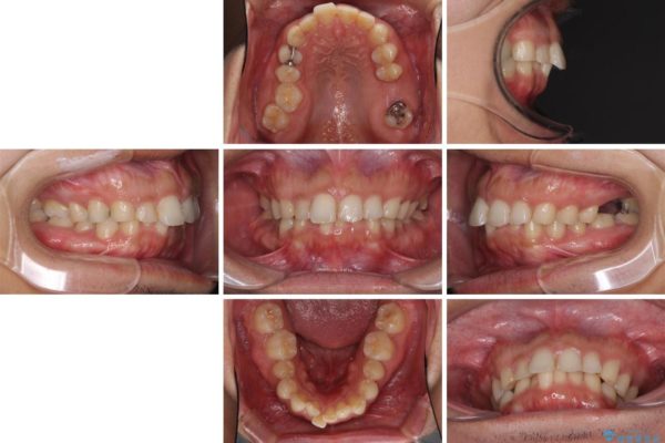 インビザラインによる矯正とインプラント補綴　深い咬み合わせと奥歯の欠損治療 治療前画像