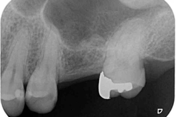 インビザラインによる矯正とインプラント補綴　深い咬み合わせと奥歯の欠損治療 治療前画像