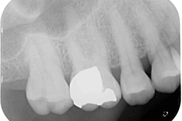外れてしまった銀歯をゴールドインレーによって修復治療 治療前画像