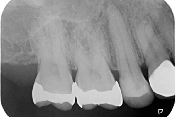 痛みが続く銀歯をセラミックに 治療後画像