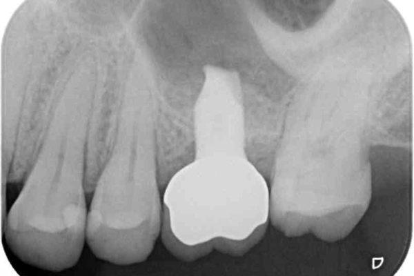 インビザラインによる矯正とインプラント補綴　深い咬み合わせと奥歯の欠損治療 治療後画像