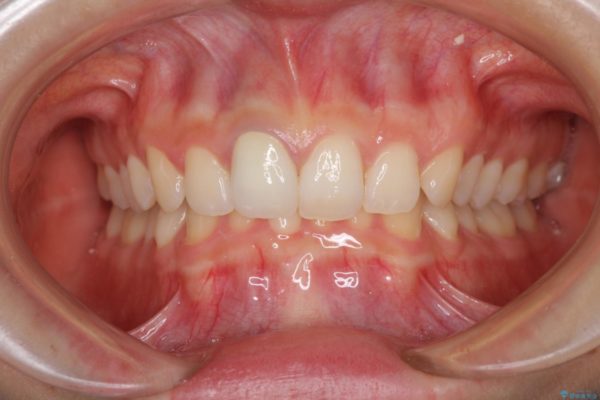 ぶつけて変色した前歯をオーダーメイドタイプのオールセラミッククラウンで美しく 治療後画像