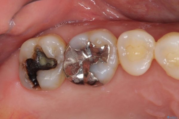 外れてしまった銀歯をゴールドインレーによって修復治療 治療前画像
