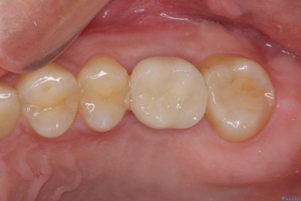 インビザラインによる矯正とインプラント補綴　深い咬み合わせと奥歯の欠損治療 治療後画像