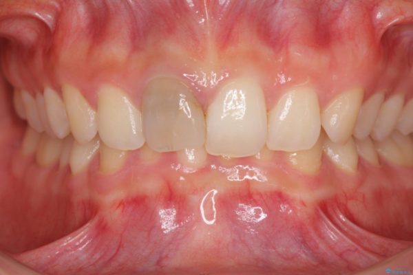 ぶつけて変色した前歯をオーダーメイドタイプのオールセラミッククラウンで美しく 治療前画像