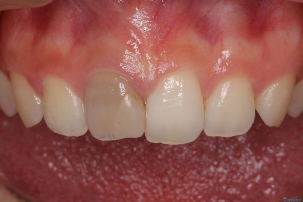 ぶつけて変色した前歯をオーダーメイドタイプのオールセラミッククラウンで美しく 治療前画像