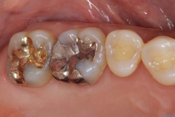 外れてしまった銀歯をゴールドインレーによって修復治療 治療後画像