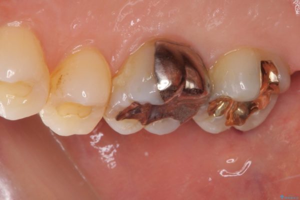外れてしまった銀歯をゴールドインレーによって修復治療 治療後画像