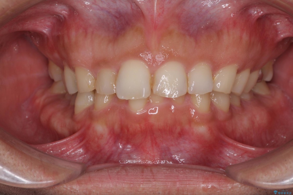 インビザラインによる矯正とインプラント補綴　深い咬み合わせと奥歯の欠損治療 治療前