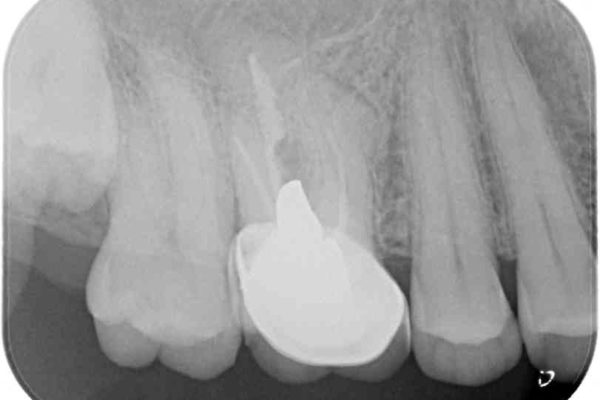 歯磨きの度に歯ぐきから出血する　歯周外科処置を伴う奥歯の補綴治療 治療前画像