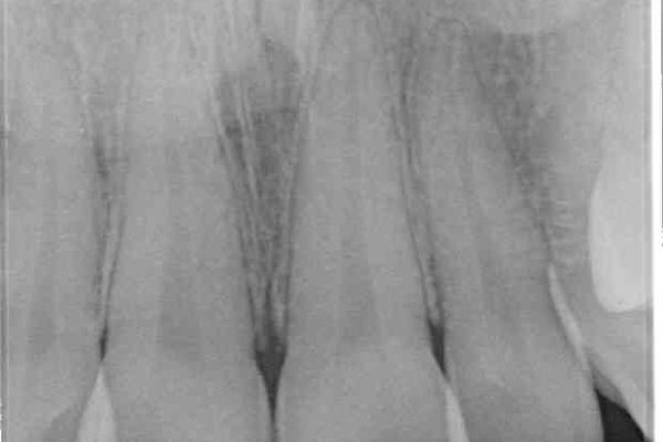 前歯の捻れを解消したい　オールセラミッククラウンによる審美治療 治療前画像