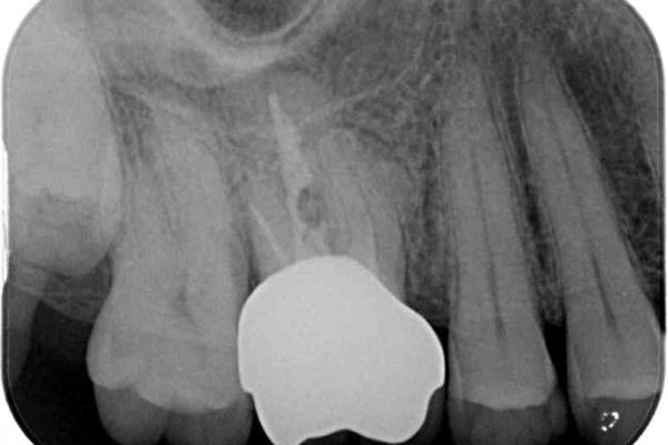 歯磨きの度に歯ぐきから出血する　歯周外科処置を伴う奥歯の補綴治療 治療後画像