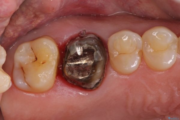 歯磨きの度に歯ぐきから出血する　歯周外科処置を伴う奥歯の補綴治療 治療前画像