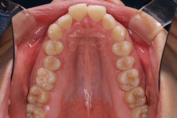 口が閉じられない　抜歯矯正で口元をスッキリと 治療前画像