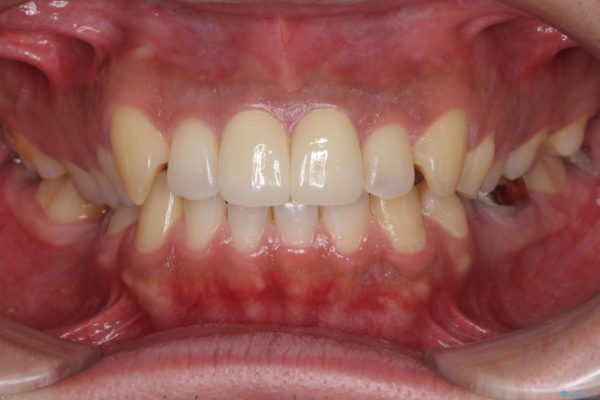 前歯の捻れを解消したい　オールセラミッククラウンによる審美治療 治療後画像