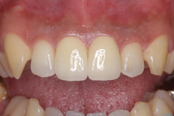 前歯の捻れを解消したい　オールセラミッククラウンによる審美治療 治療後画像