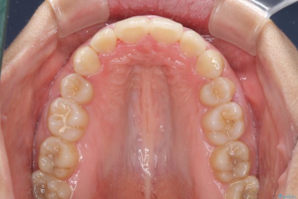 口が閉じられない　抜歯矯正で口元をスッキリと 治療後画像