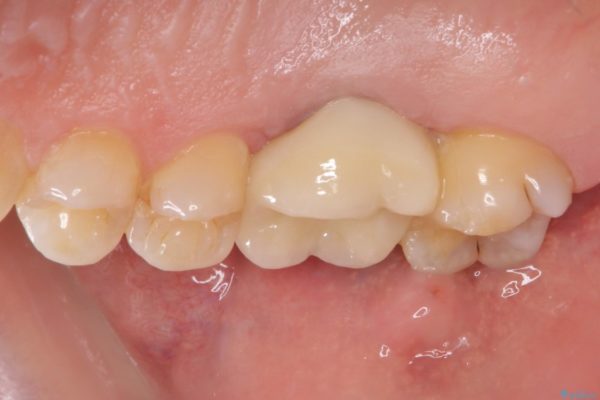 歯磨きの度に歯ぐきから出血する　歯周外科処置を伴う奥歯の補綴治療 治療後画像