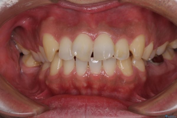 前歯の捻れを解消したい　オールセラミッククラウンによる審美治療 治療前画像