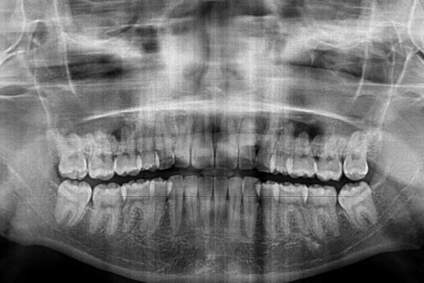 口が閉じられない　抜歯矯正で口元をスッキリと 治療後画像