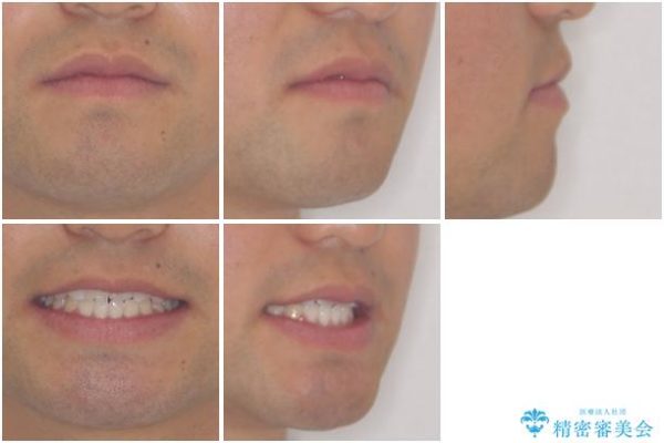 美容歯科でも断られた　著しい前歯のクロスバイトをワイヤー矯正で改善 治療後画像