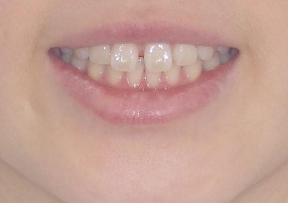 インビザラインによるすきっ歯の治療 治療前画像
