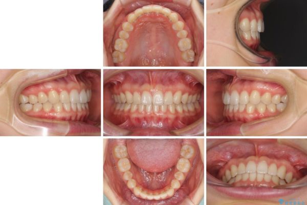 インビザラインによるすきっ歯の治療 治療後画像